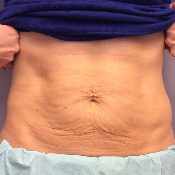 What You Need to Know About Skin Tightening for Your Stomach — Spa Rockaway