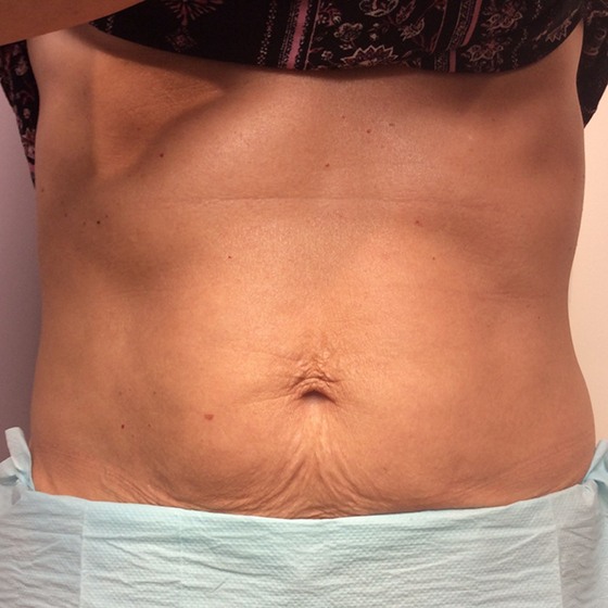 Tummy Tightening with Sublime™  Enlighten Laser and Skin Care Clinic